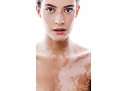Vitiligo Treatment